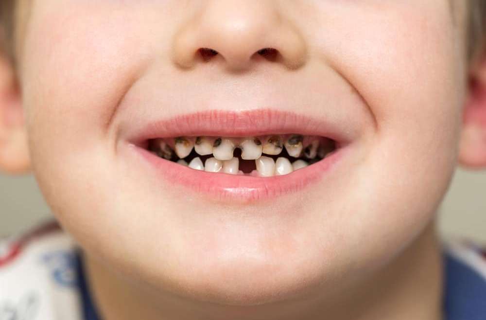 Neden çocuklarda diş çürümesi daha fazla görülür?