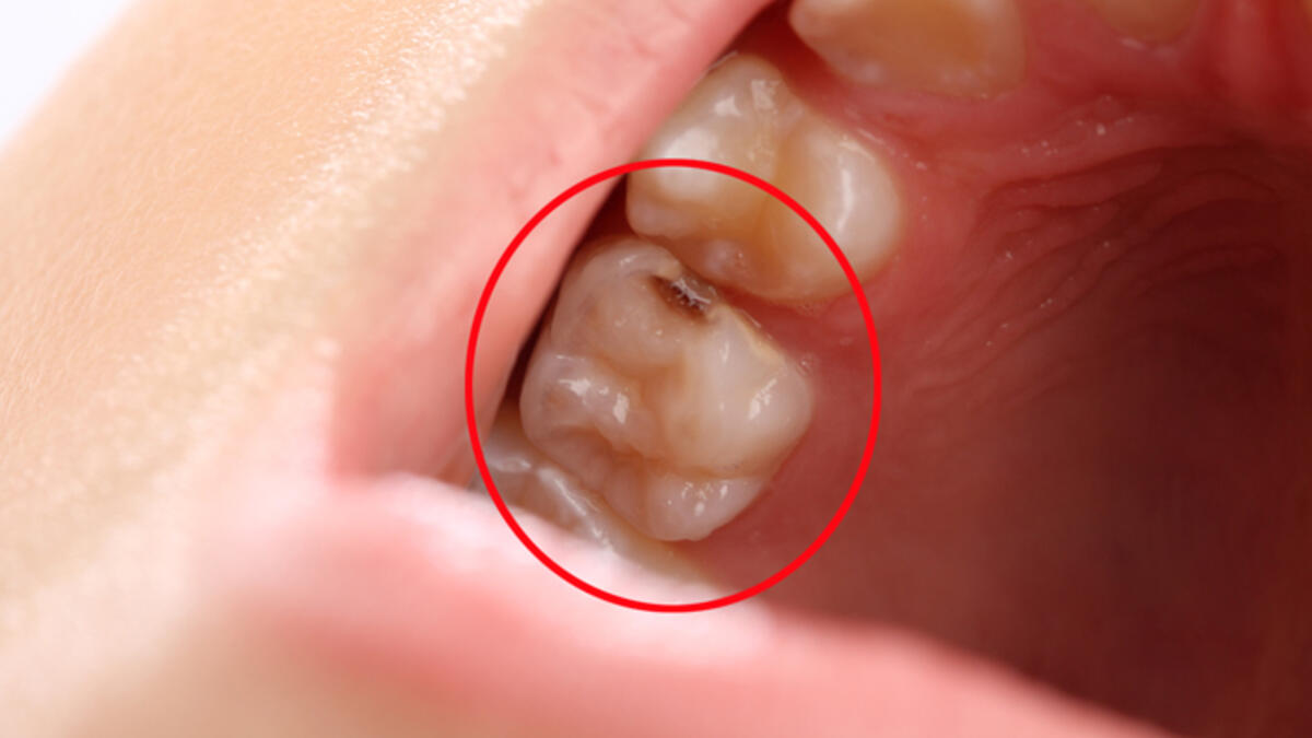 Diş Çürüğü tedavisinde neler yapılmalıdır?