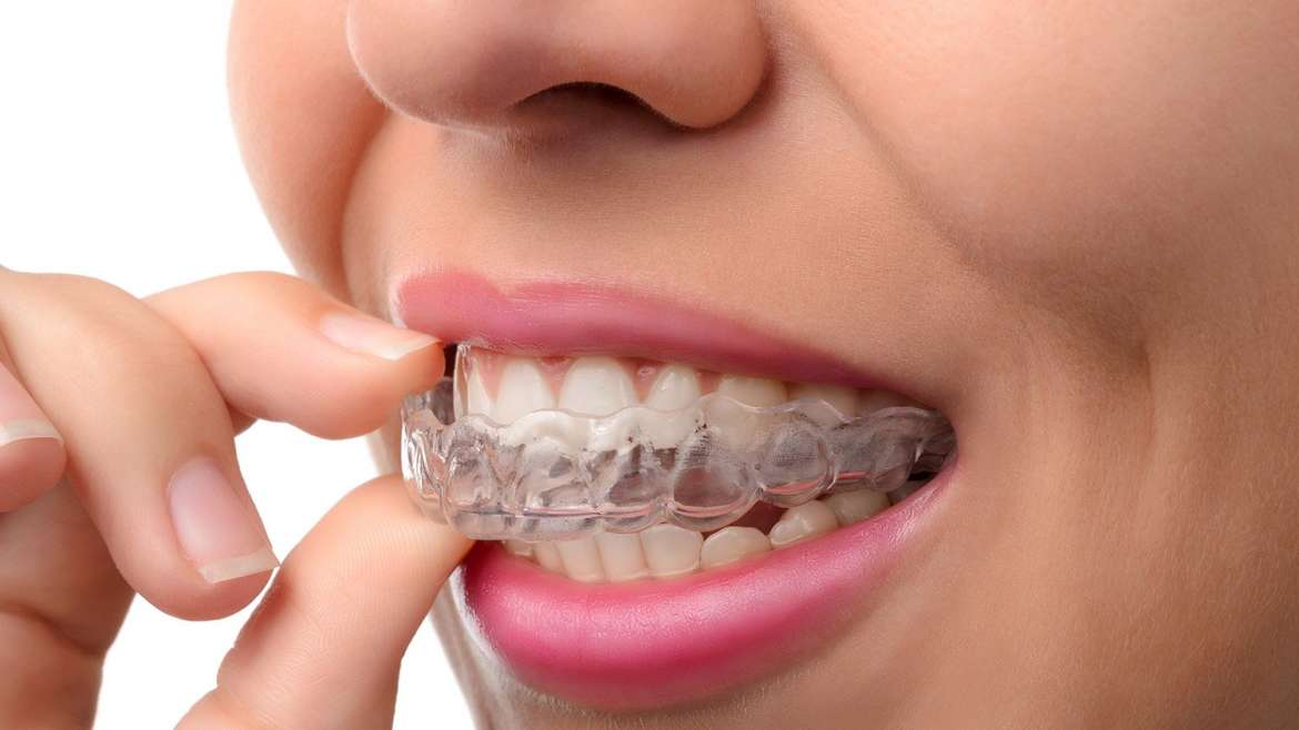 Ortodontik Tedavisi (Tel Tedavisi) nedir? Niçin uygulanır?